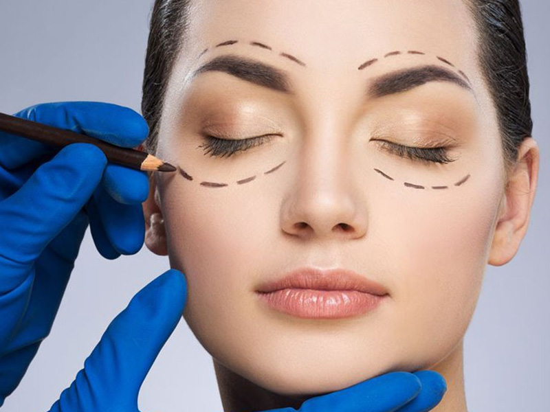 بلفاروپلاستی