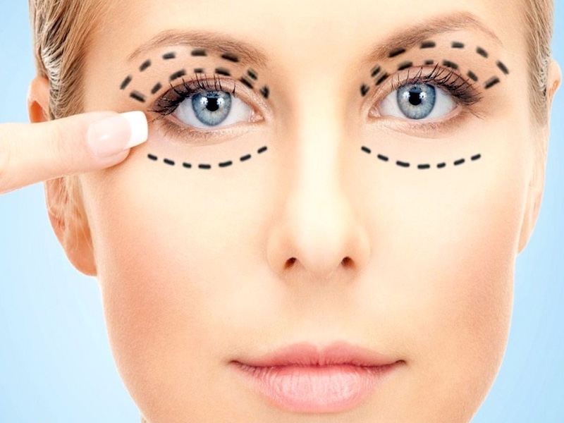 جراحی زیبایی پلک بالا