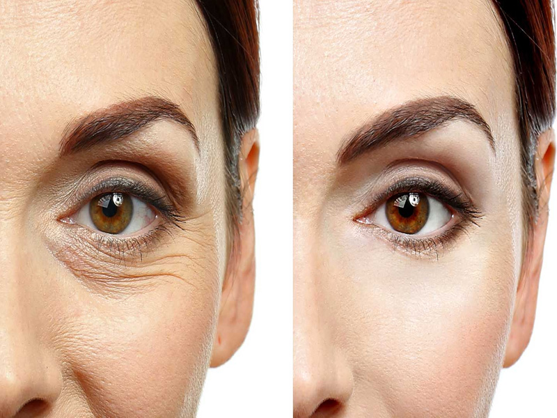 جراحی زیبایی پلک پایین