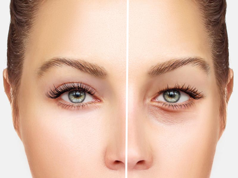 بهترین جراح پتوز پلک در شریعتی