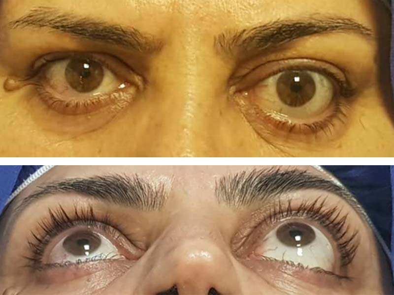 همه چیز درباره تومورهای اربیت