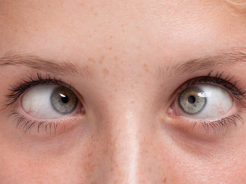 استرابیسم یا انحراف چشم چیست؟