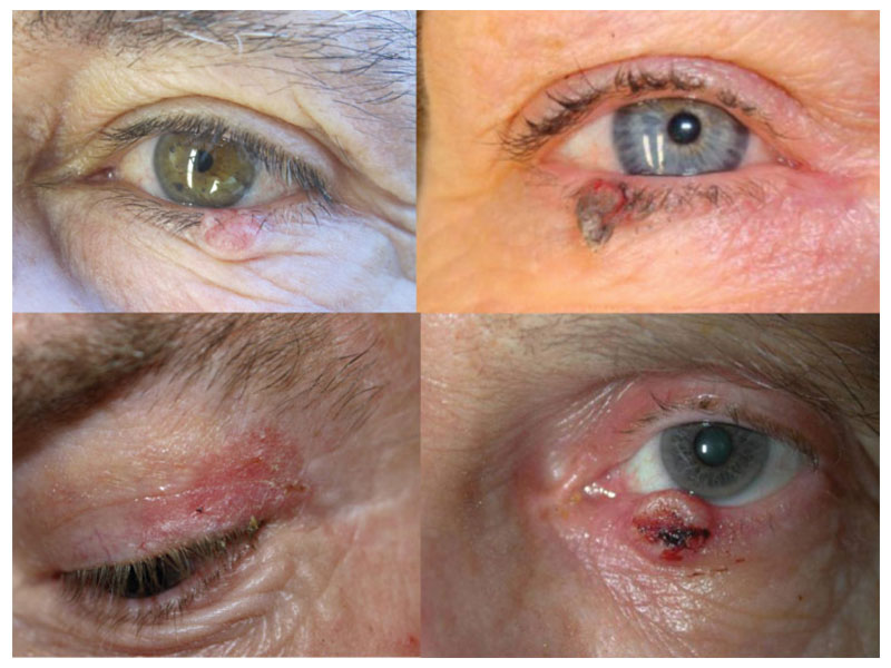 انواع ضایعات و تومورهای پلکی