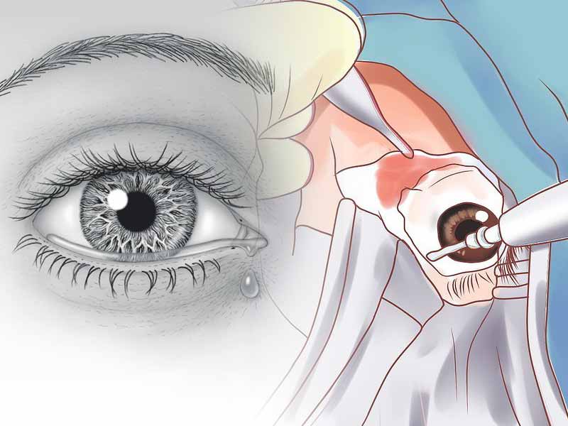 انسداد مجرای اشکی، از بروز تا درمان