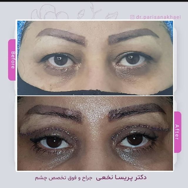 بلفاروپلاستی تمام رخ