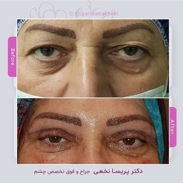 بلفاروپلاستی پلک های فوقانی