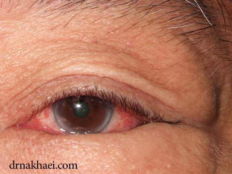 همه چیز درمورد بیماری انتروپیون