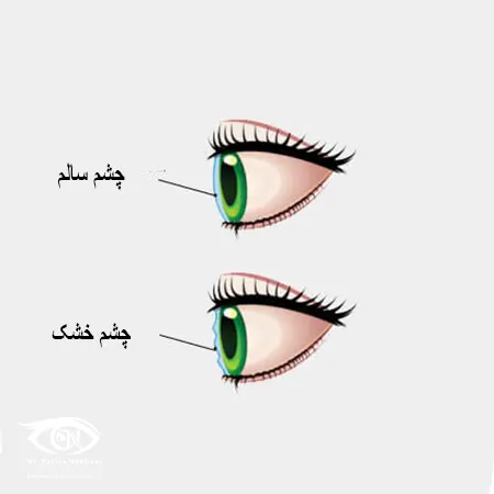 خشکی چشم