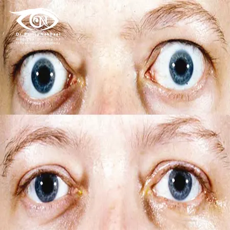 تیروئید چشمی