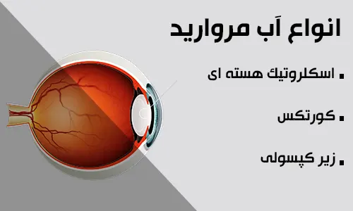 انواع آب مروارید