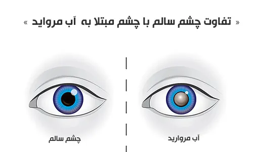 تفاوت چشم سالم با چشم مبتلا به آب مروارید