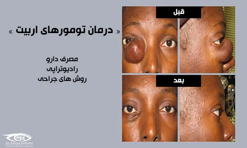 درمان تومور اربیت