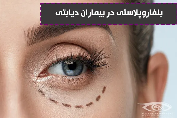 بلفاروپلاستی در بیماران دیابتی