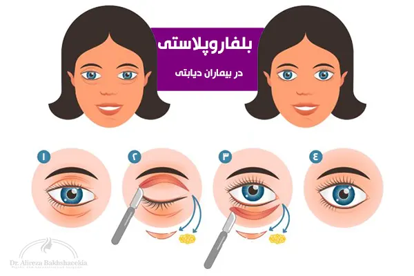 بلفاروپلاستی در بیماران دیابتی