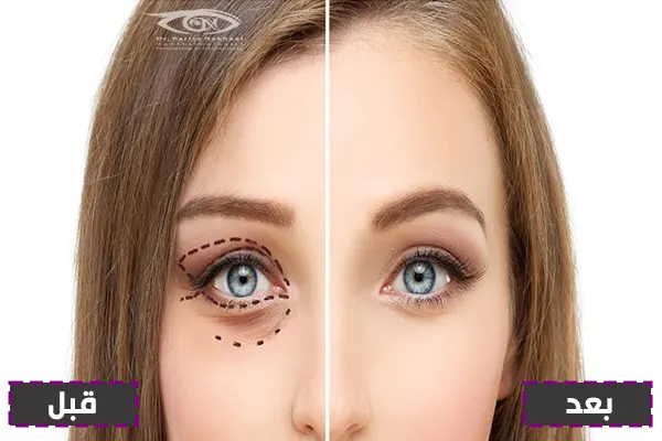 بلفاروپلاستی در بیماران دیابتی