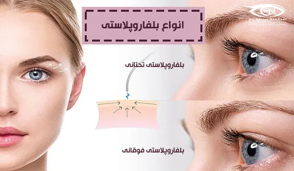 انواع بلفاروپلاستی