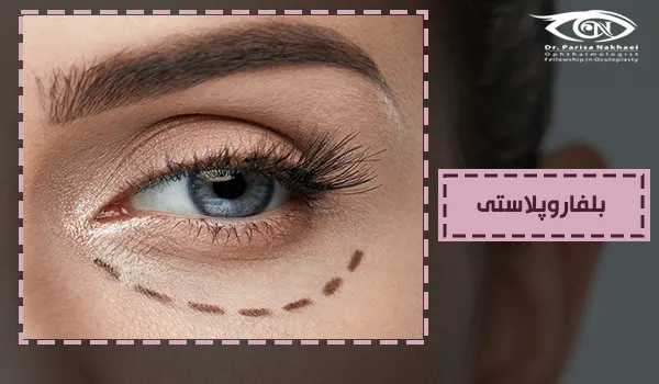 جراحی زیبایی پلک